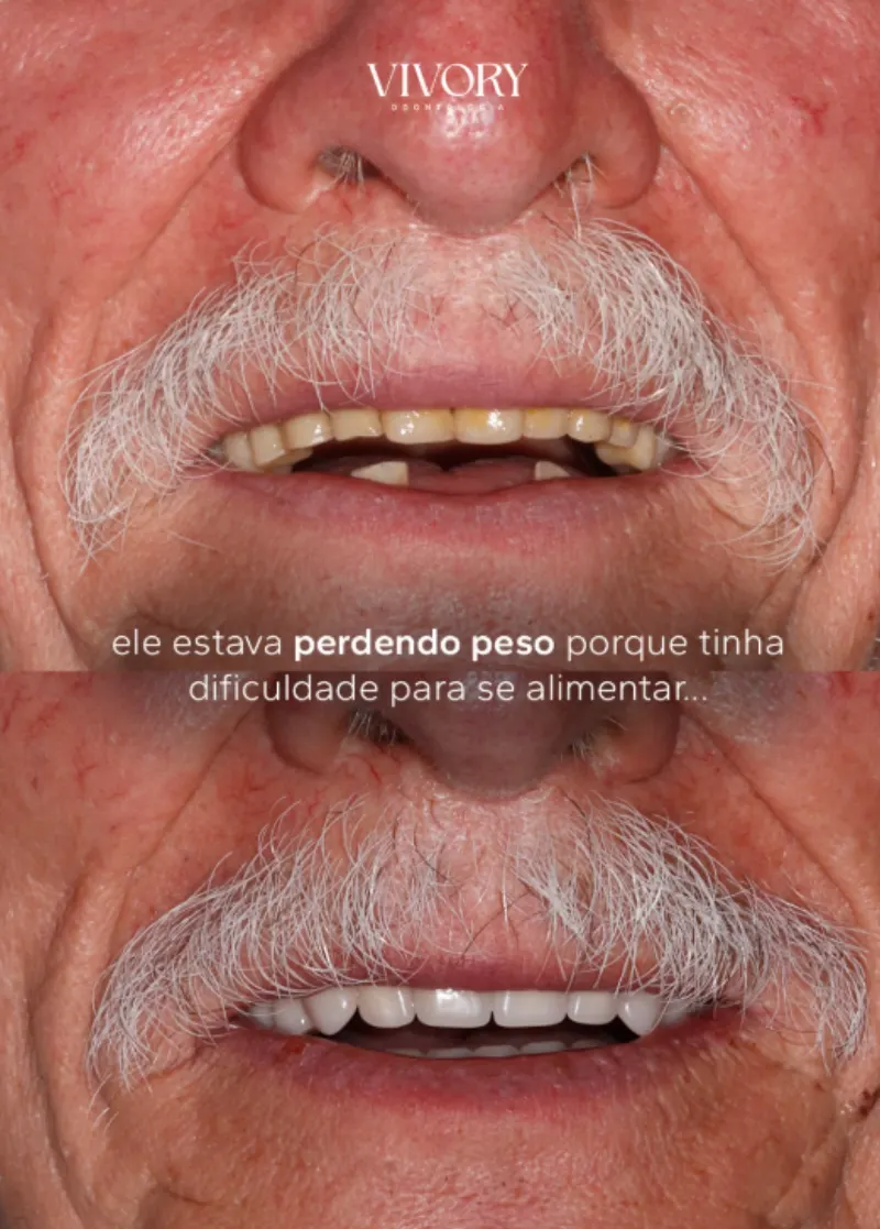 Reabilitação oral — antes e depois