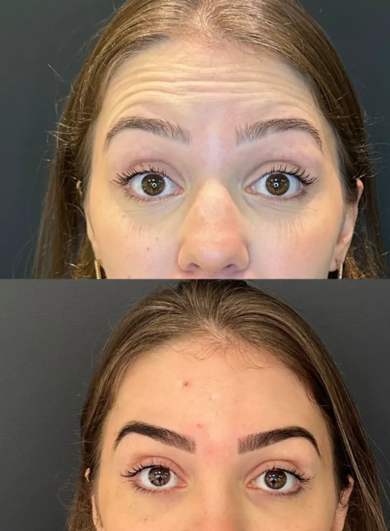 Toxina botulínica — antes e depois na testa